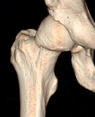 3d reconstruction of cam lesion in FAI