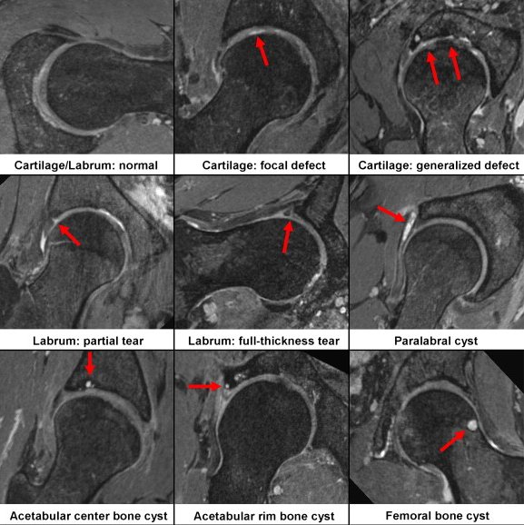 MRI showing wear in the hip